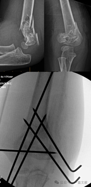 Treatment of Pediatric Supracondylar Humerus Fractures