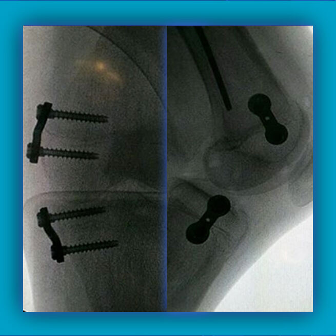 Half Epiphyseal Block Surgery for Children's Limbs