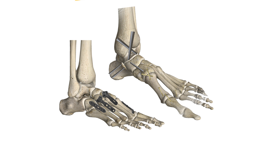 Comprehensive Fracture Management Solutions