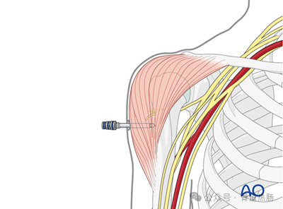 External fixation（Simple humeral shaft fracture, spiral fracture.）