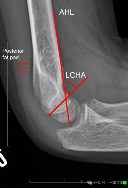 Treatment of Pediatric Supracondylar Humerus Fractures