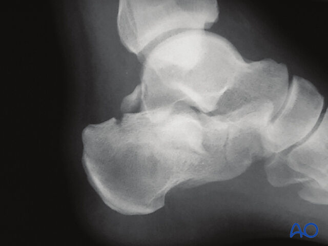 Den udvidede laterale tilgang til calcaneus – den store L-formede indskæring