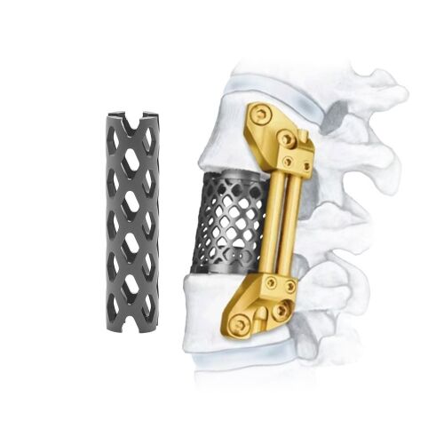 Spinal Implants for Spinal Fusion Augmentation Enhancing Fusion Success Rate