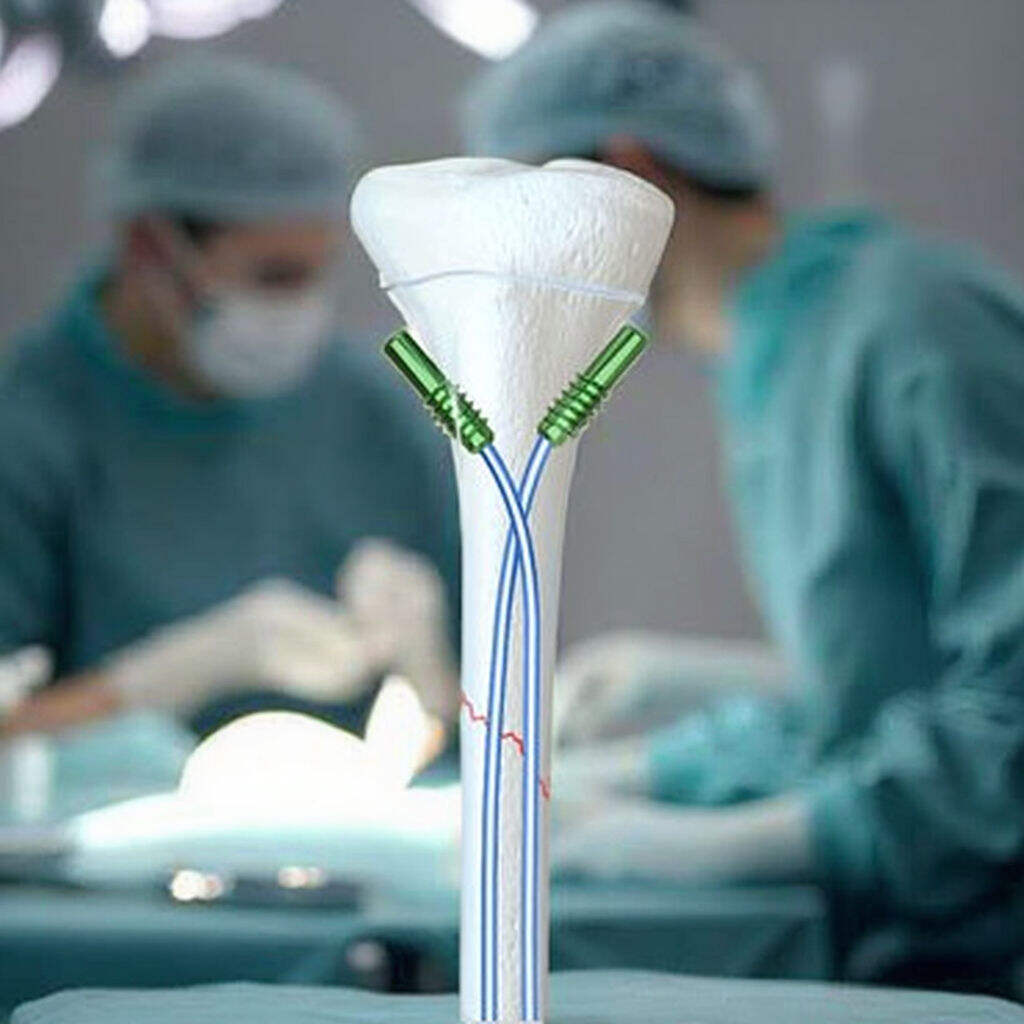 คุณภาพและประสิทธิภาพที่เหนือชั้นของตะปูยึดไขกระดูกต้นขาแบบเข้าไปในโพรงไขกระดูก