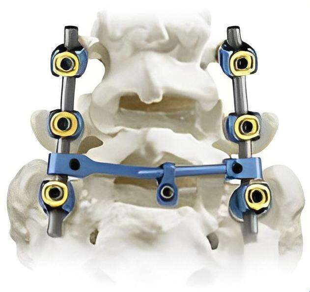 Unmatched Performance of Geasure Multifunctional Pedicle Screw