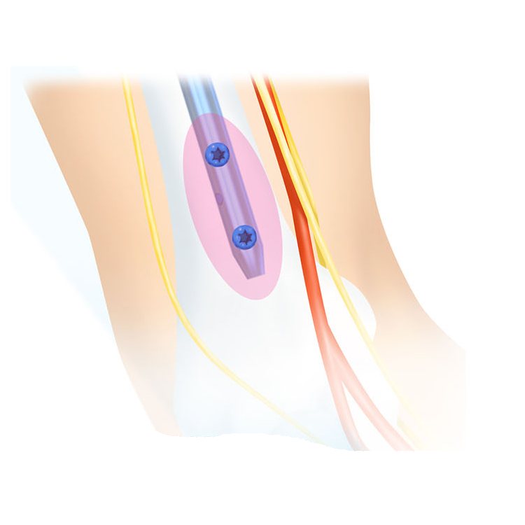 Unmatched Quality and Precision in Humeral Nail Solutions