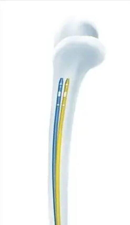 Conception Minimale Invasive