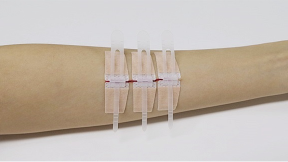 Wound Closure Device: